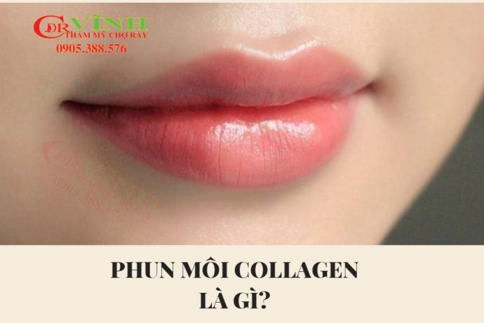 phun-moi-collagen-bac-si-vinh-khoa-tham-my-benh-vien-cho-ray-1