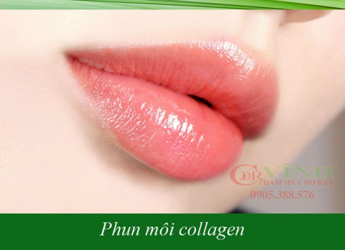 phun-moi-collagen-bac-si-vinh-khoa-tham-my-benh-vien-cho-ray-2